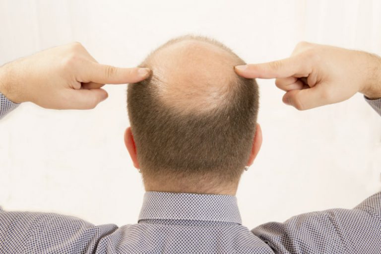 Common Questions People Have About Hair Restoration in Pennsylvania